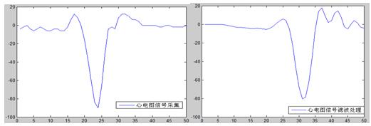 實(shí)際心電圖信號(hào)的采集與處理效果圖