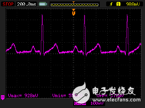 監護儀模擬輸出端顯示出從電力線耦合而來的噪聲