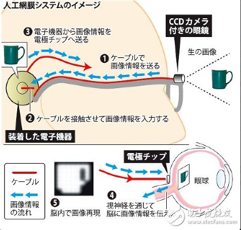 日本人工視網膜用電子芯片代替視網膜細胞發揮作用